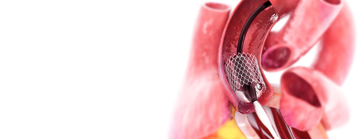 Complex Angioplasty vs. Bypass Surgery: Which One Is Right for You?